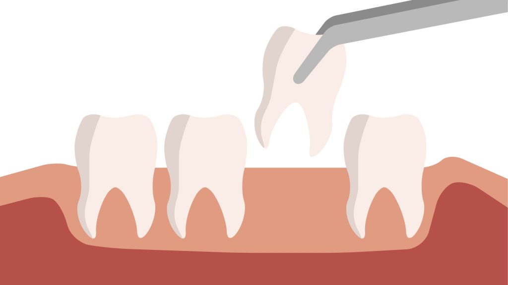How Long After Tooth Extraction Can I Eat